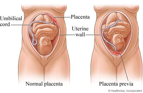Normal placenta and placenta previa.