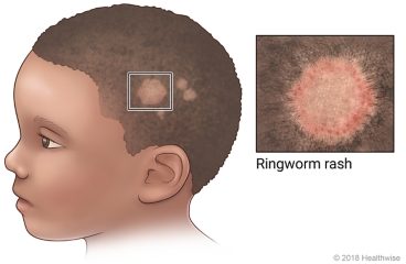 Close-up of ringworm rash on side of head.