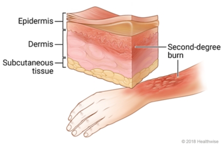 Second-degree burn on arm, with cross-section of skin showing redness and swelling in top two skin layers