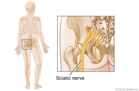 A skeleton showing the location of the sciatic nerve and close-up of the sciatic nerve in the hip area
