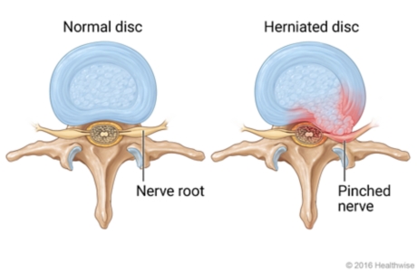 Top view of normal disc with healthy nerve root and top view of herniated disc with pinched, inflamed nerve