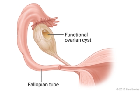 A fallopian tube showing a functional ovarian cyst
