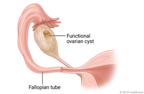 A fallopian tube showing a functional ovarian cyst.