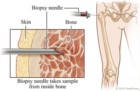 Skeletal view of lower body, with cross-section view of biopsy needle taking sample of bone