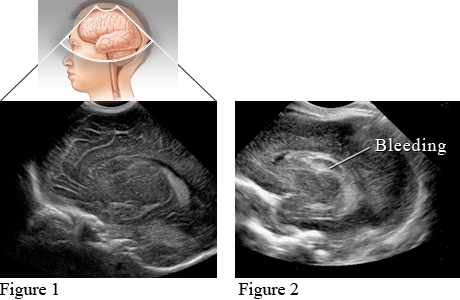 Sonogram of a healthy newborn brain and of a brain showing bleeding