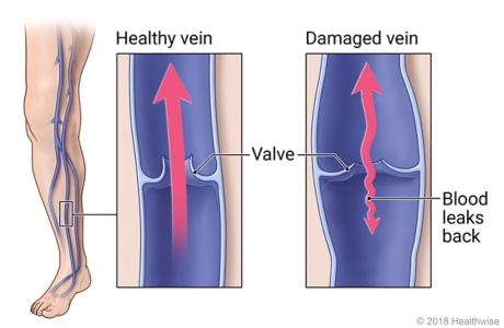 Veins in leg, with detail of healthy vein and valve and of damaged vein that allows blood to leak backward