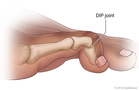 A mallet toe bent down at the joint near the tip of the toe