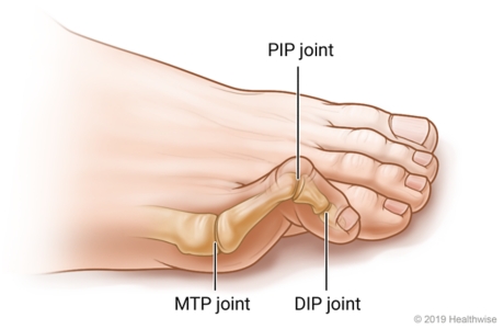 Hammer toe showing the middle toe joint bent up