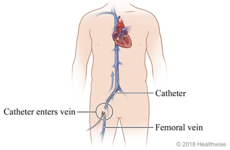 Femoral vein and its location near the groin, where catheter enters vein