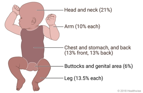 Baby with areas of body marked to show percentages of surface area.