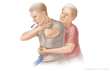 Choking rescue procedure (Heimlich manoeuvre)