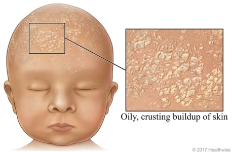 Cradle cap on baby's scalp, with close-up of oily, crusty buildup of skin