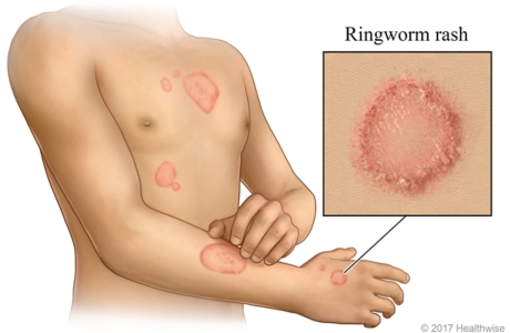Ringworm skin rash on arm and chest, with a close-up of rash