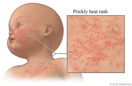 Prickly heat rash