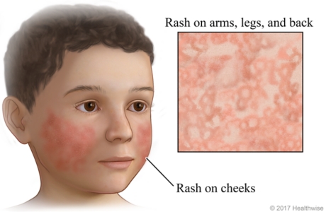Fifth disease rash on face, with close-up of second-stage body rash