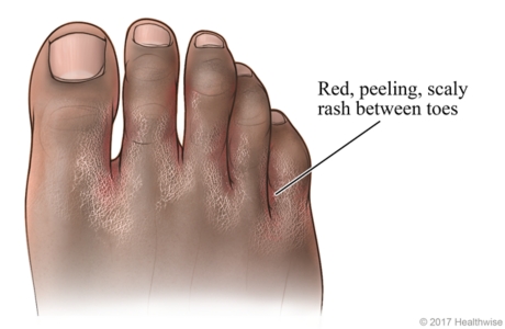 Foot with toe web type athlete's foot between toes