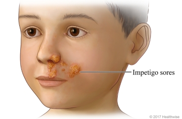 Patches of impetigo on child's upper lip, lower nose, and cheek.