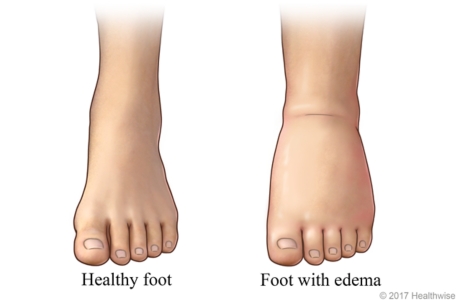 Normal foot and ankle, and foot and ankle with edema