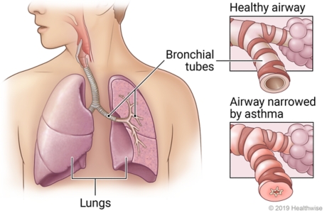 Lungs in chest showing bronchial tubes in left lung, with detail of healthy airway and airway inflamed by asthma