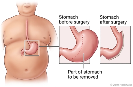 Location of stomach in upper belly, with detail of stomach before and after gastric sleeve surgery