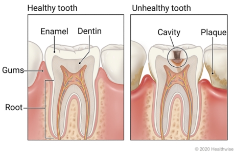 Healthy tooth showing layers of enamel, dentin, and root, and unhealthy tooth with plaque showing cavity affecting layers of tooth