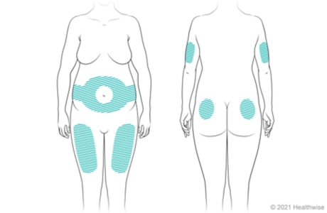 Front and back of woman's body, showing areas where insulin may be injected.