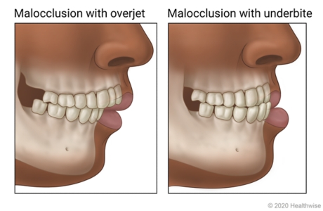Jaws showing malocclusion, one showing an overjet and one an underbite