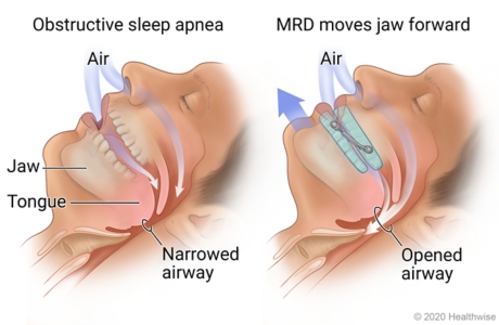 Sleeping person with narrowed airway from sleep apnea, and then using MRD showing jaw moved forward and airway opened.