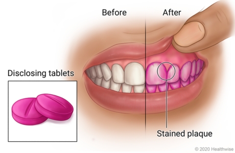 Plaque on teeth stained red by disclosing tablets, with detail of disclosing tablets.