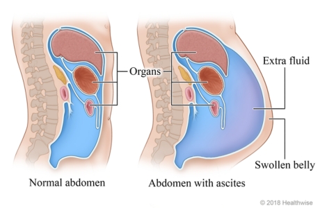 Cross section of organs in abdomen, showing normal abdomen and abdomen with extra fluid (ascites).