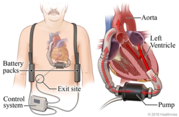 Location of VAD pump, battery packs, and controller, with detail of VAD pumping blood from heart's left ventricle to the aorta.