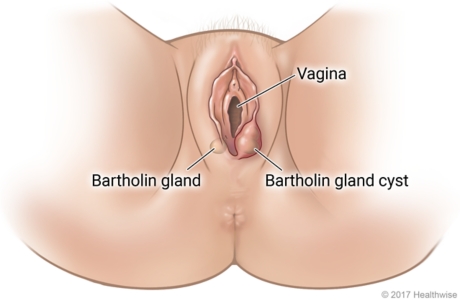 Female genital area, showing a healthy Bartholin gland and a Bartholin gland cyst