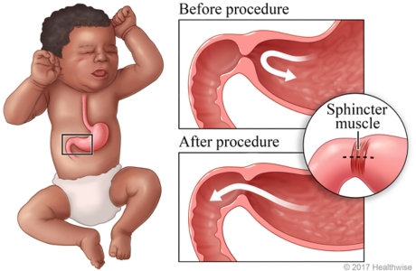 Location of pylorus in baby's abdomen, with detail of narrowed pylorus (stenosis) before and after surgery