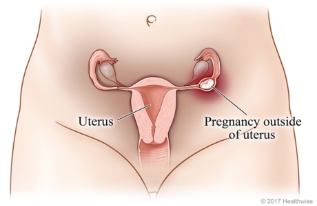 Reproductive system, showing pregnancy outside uterus in fallopian tube.
