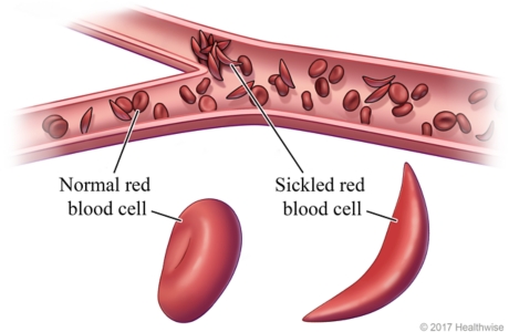 Inside view of red blood cells in blood vessel, with close-up of normal and sickled red blood cells