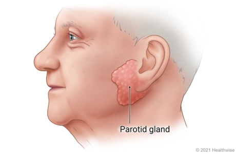 Side view of person's face, showing parotid gland in front of and slightly below ear.