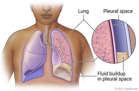 Lung with fluid buildup in pleural space, with detail of pleural space and fluid buildup.