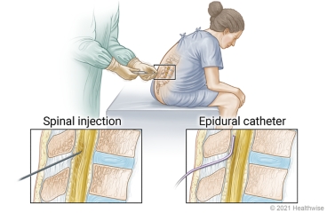 Doctor inserts needle near the spinal cord in seated person's back, with details of spinal injection site and epidural catheter placement.