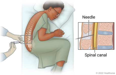 Person lying on side with knees pulled up toward chest getting lumbar puncture, with detail of needle inserted into spinal canal.