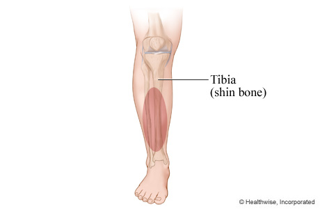 Location of shin splints.