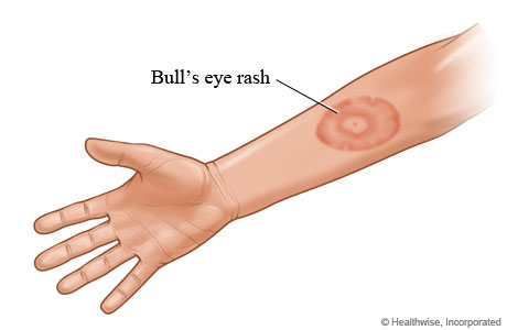 Lyme disease "bull's eye" rash