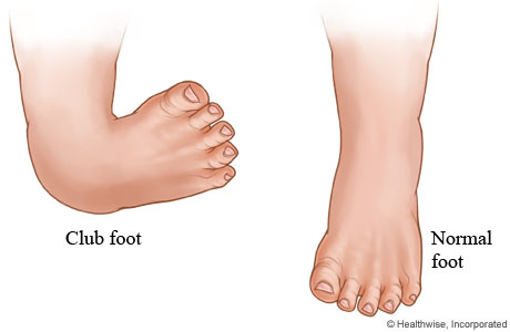 Club foot and normal foot