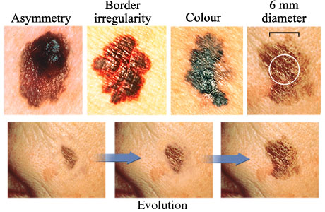 Photos of various melanoma, showing one with asymmetry, one with border irregularity, one with varied colour, and one larger than 1/2 centimetre, and three images showing evolution of size of melanoma.