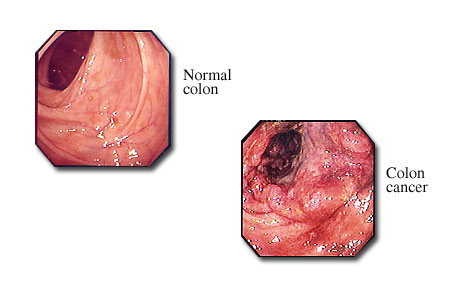 Colon cancer visible with a colonoscope.