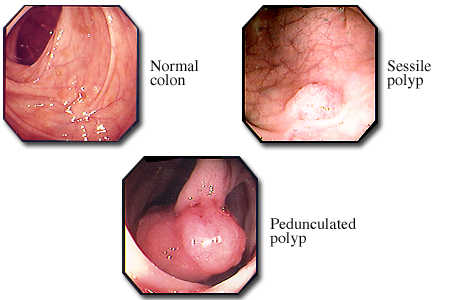 Colon polyps and a normal colon