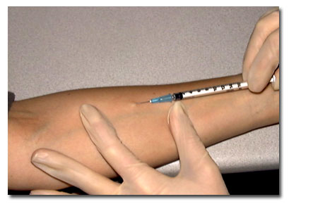 Mantoux tuberculin skin test.