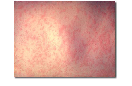 Measles rash