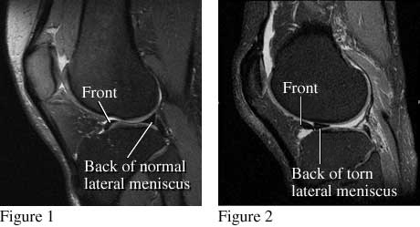 MRI images of torn meniscus