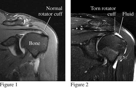 MRI images of torn rotator cuff.