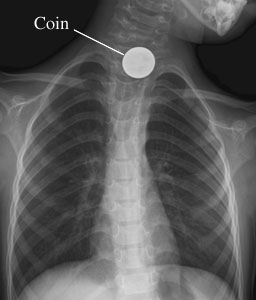 X-ray of swallowed object